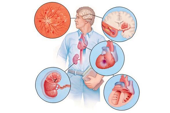 Schädigung mehrerer Organe mit längerer arterieller Hypertonie